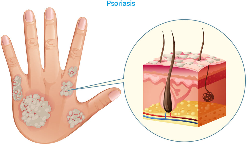 Red Light and Psoriasis