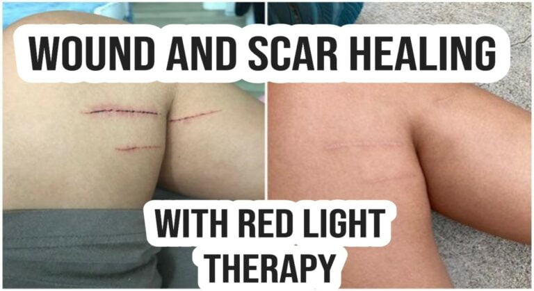 Wound and Scar Healing with Red Light Therapy